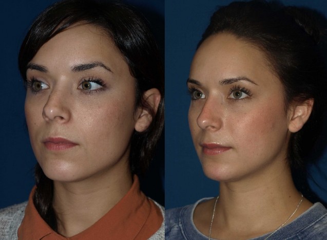Rhinoplasy Before and After