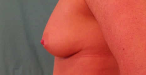 Breast Before