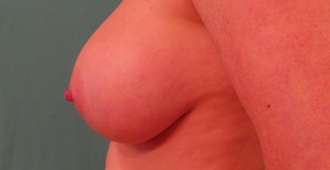 Breast After