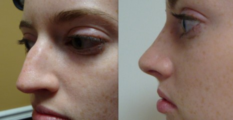 Rhinoplasty Before and after