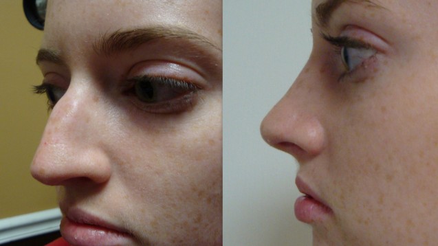 Rhinoplasty Before and after