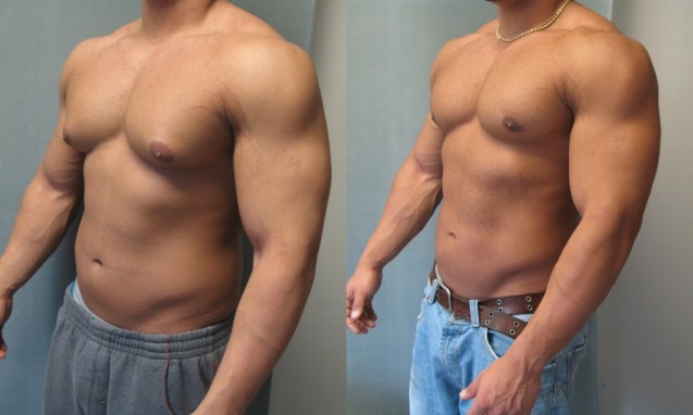 Good Results With Surgery For Gynecomastia In Bodybuilders