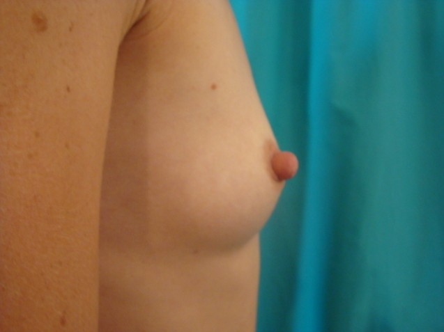 Breast Before